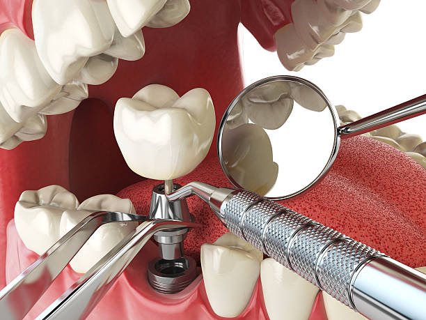 Best Emergency Root Canal Treatment in Olympia, WA
