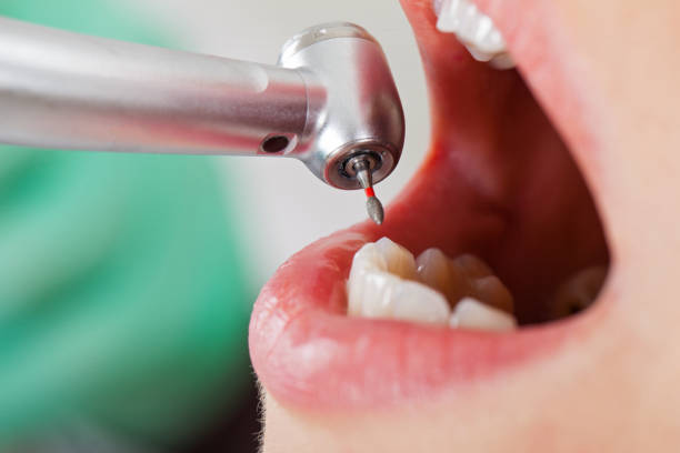 Best Emergency Root Canal Treatment in Olympia, WA